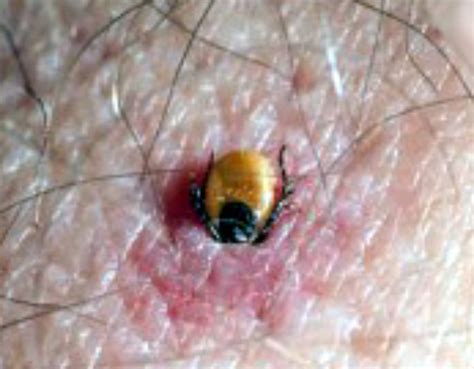 Tick Paralysis Lyme Disease Association