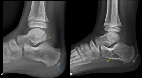 Figure 6 From Calcaneal Apophysitis Sever´s Disease A Poorly
