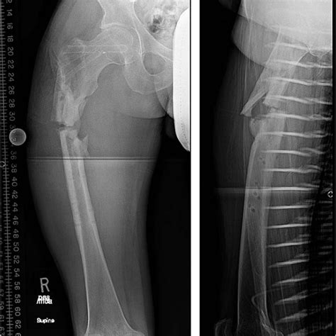 A And B Ap And Lateral Radiographs Showing The Fracture Through