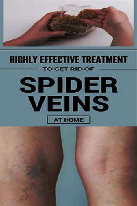 Use Natural Methods To Remove Spider Veins Spider Veins Remove Spider Veins Spiderveins