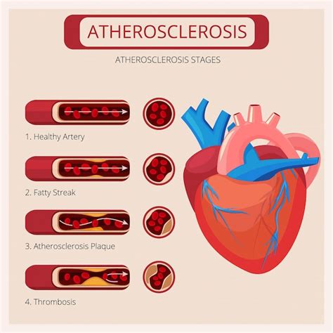 Atherosclerosis Stages Heart Strokes Thrombus Attack Blood Circulatory