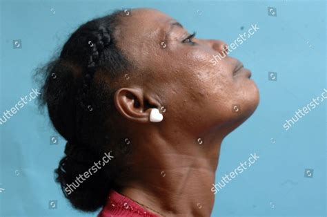 Middleaged Woman Suffering Small Toxic Goitre Editorial Stock Photo