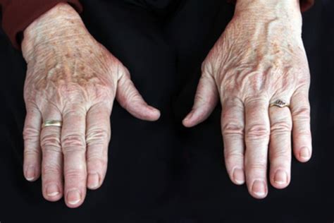 First Symptoms Of Cancer Appear On The Hands
