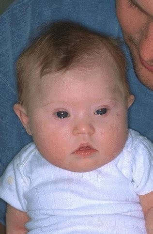 Distinct features of the face, hands, and feet are common. Down syndrome features. Causes, symptoms, treatment Down ...