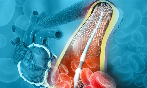 What Is An Angioplasty Types And Stents Pulse Cardiology