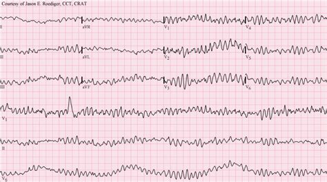 Ventricular Fibrillation Ecg Example 1 Learn The Heart