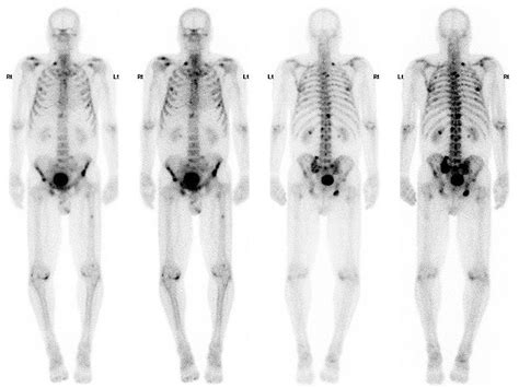 Appropriate Use Of Bone Scintigraphy To Diagnose Metastases