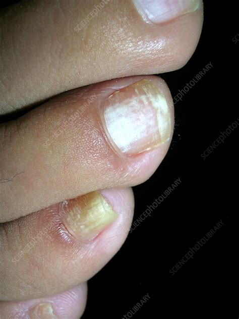 Fungal Nail Infection Stock Image C0562583 Science Photo Library