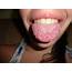 Mystery Geographic Tongue Condition Explained By Physics