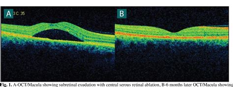 Figure 1 From Bilateral Serous Retinal Detachment In Preeclampsia Case