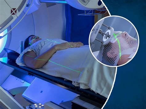 What Are The Side Effects Of Radiation Therapy Know From An Expert