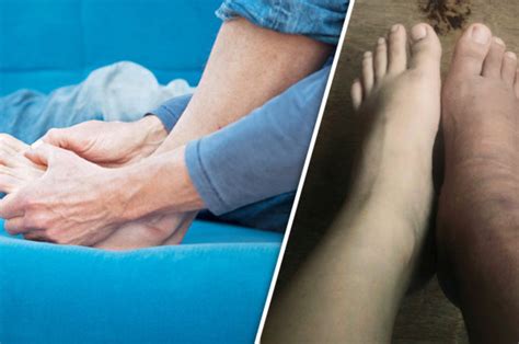 Your Swollen Ankles Could Be A Sign Of This Very Serious Health Issue