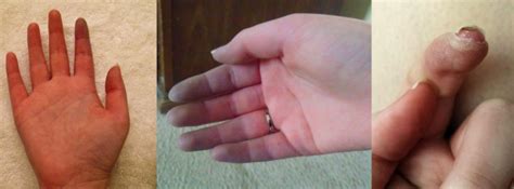 15 Photos That Show What It Looks Like To Live With Raynauds Syndrome