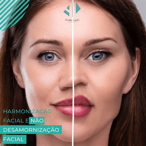 Harmonização Facial Ou Desarmonização Facial André Lauth Dermato