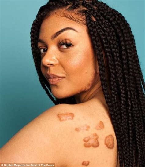 Woman Proudly Shows Off Her Keloid Scars In Viral Photos Big World Tale