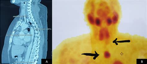 Giant Ectopic Parathyroid Adenoma Of The Mediastinum Causing Primary
