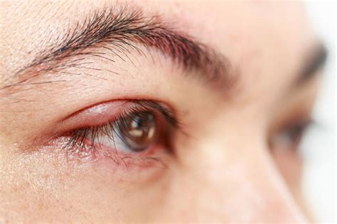 Treatment And Symptoms Of A Stye On The Eyelid