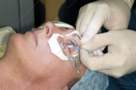 Laser Eye Surgery Stock Image C Science Photo Library