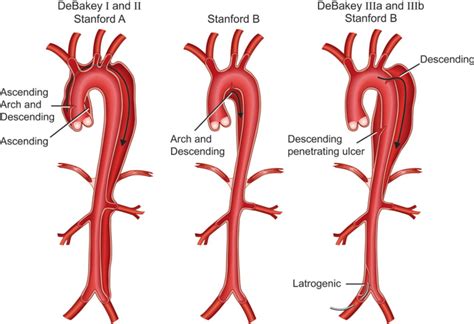 Stanford And Debakey Classifications Of Aortic Dissection Figure From