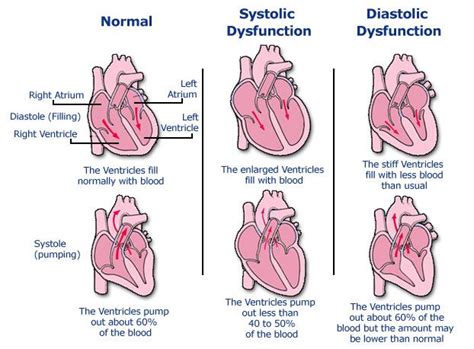 Pathology And Clinical Manifestation Symptomatology Of Heart Failure