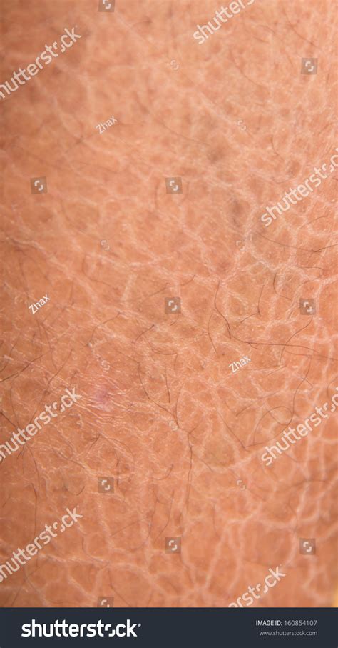 Dry Skin Ichthyosis Detail Stock Photo 160854107 Shutterstock