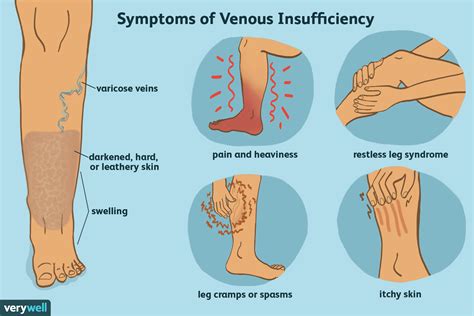 Una descripción general de la insuficiencia venosa Medicina Básica