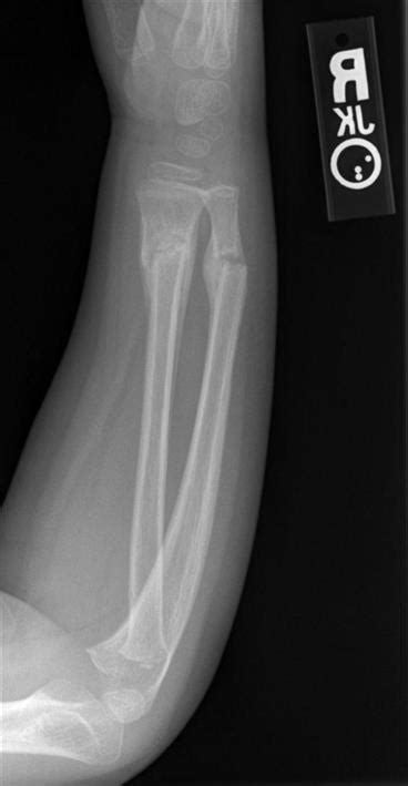 Greenstick Fracture Treatment