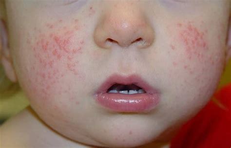 Acrodermatitis Causes Symptoms Treatment And Prevention