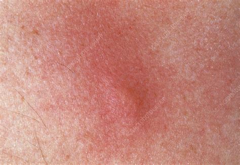 Aggravated Mosquito Bite On A Patients Skin Stock Image M3200264