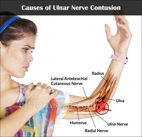 Ulnar Nerve Contusionsymptomscausestreatment Cold Therapy Cast