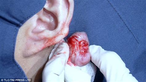Woman 29 Has Lumps Sliced Off Her Ears By Dr Pimple