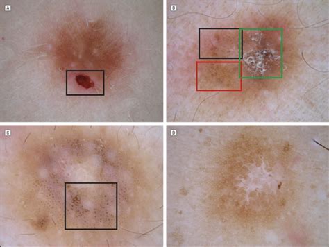 Dermoscopy Of Dermatofibromas A Prospective Morphological Study Of 412