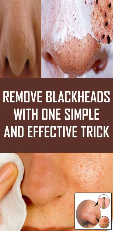 Pin On Blackheads Remedies