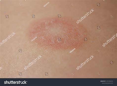 Pityriasis Rosea Herpes Red Spots On Foto De Stock The Best Porn Website