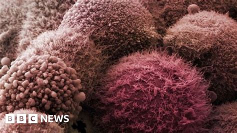 Pancreatic Cancer Urine Test Hope Bbc News