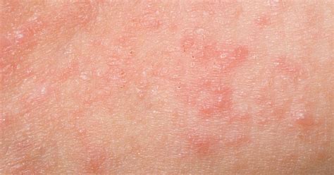 What Is Scabies Everything You Need To Know About Scabies Rash Images