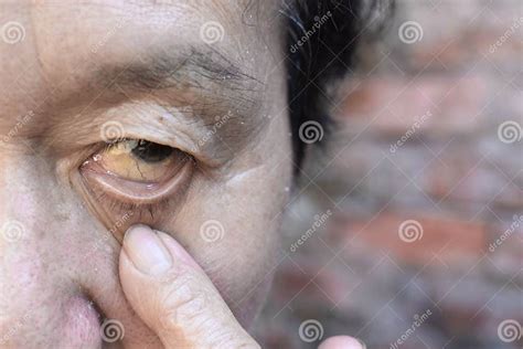 Pale Skin Of Asian Man Sign Of Anemia Pallor At Eyelid Stock Photo
