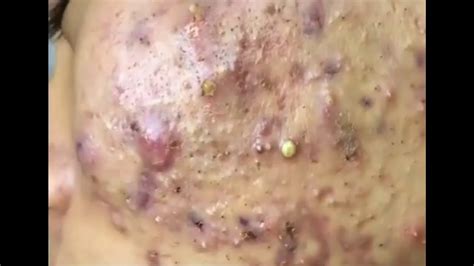Big Pimple Popping Satisfying Blackhead Face Removal 2021 Unbelievable