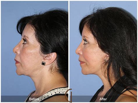Facial Fat Grafting Before And After Photos From Dr Kevin Sadati