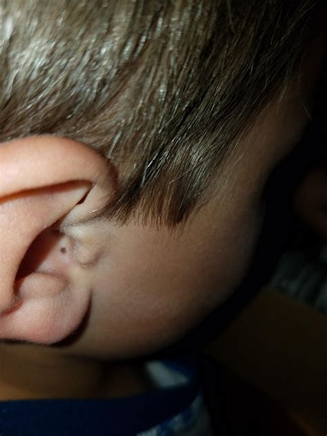 My 5 year old has an ear blackhead. I hope he will sit still long