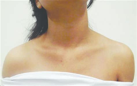 Maintained Rounded Contour Of Left Shoulder With Wasting No Obvious