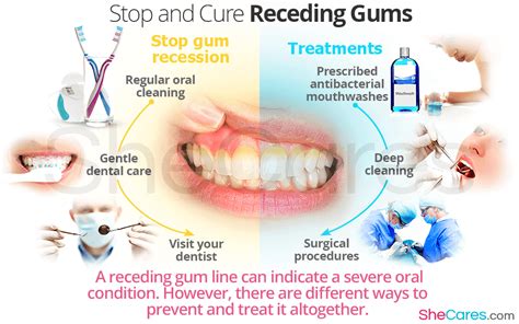 Natural Remedies For Receding Gums Change Comin