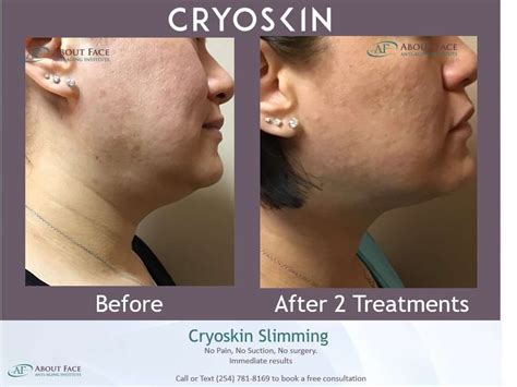 Cryoskin Slimming Before And After Harker Heights Killeen Tx 1