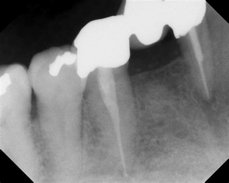 Lower Jaw Cyst Lower Jaw Cyst Kazemi Oral Surgery