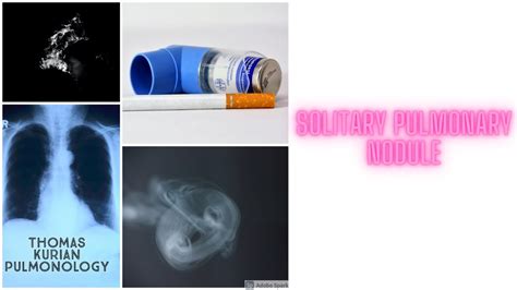 Solitary Pulmonary Nodule Youtube