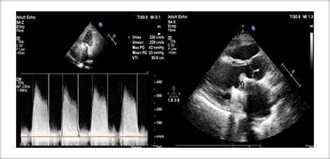 Mechanical Mitral Valve Thrombosis In A Patient With Covid 19 Infection