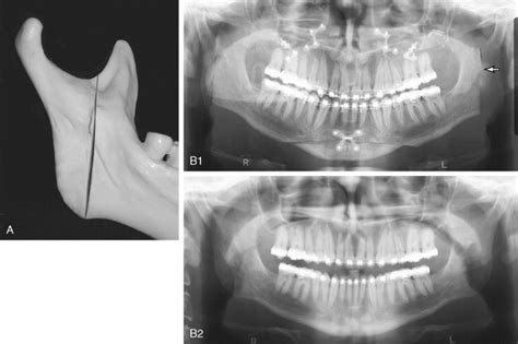 Complications With Orthognathic Surgery Pocket Dentistry