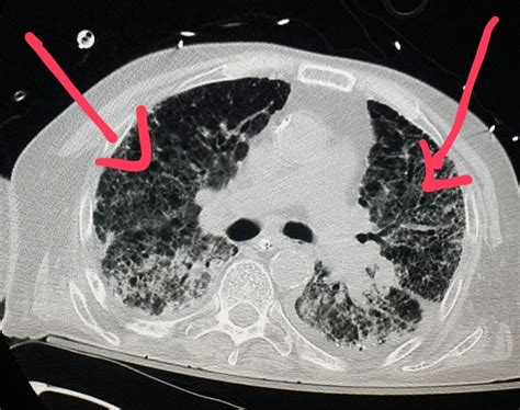 Chest Ct Scan Shows Lung Scarring And Fibrosis In A