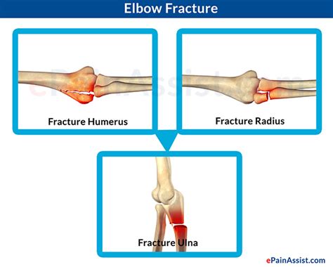 Causes And Symptoms Of Elbow Joint Pain