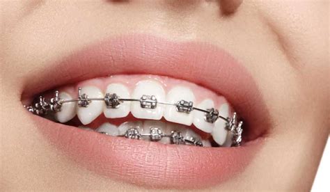 How Long Do You Have To Wear Braces If You Have An Overbite How Long